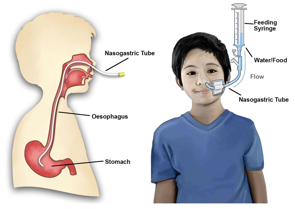 Nasogastric-Tube.jpg Nasogastric Tube - Image 1
